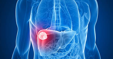 Liver Cancer